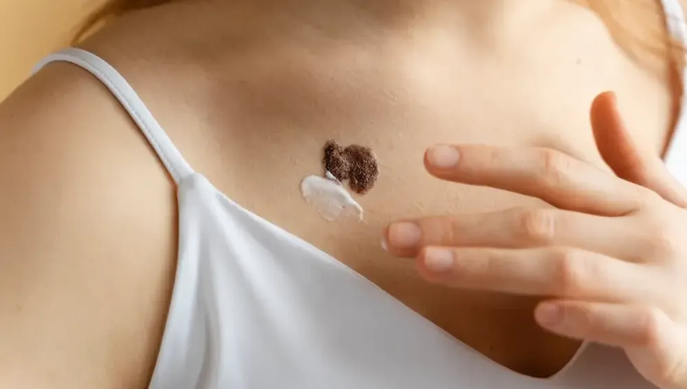 7 Fakta Keloid: Bisa Hilang, Cara Cegah, Solusi di Surabaya Skin Centre - Surabaya Skin Centre