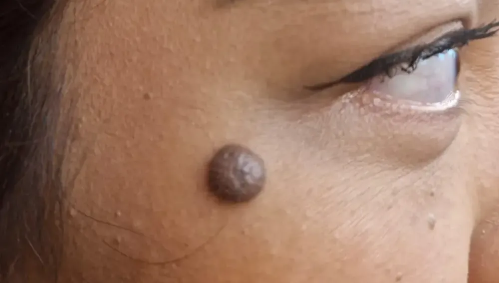 Menghilangkan Tahi Lalat : Laser, Eksisi, atau Elektrokauter? Ini Penjelasan Lengkapnya oleh dokter Surabaya Skin Centre - Surabaya Skin Centre