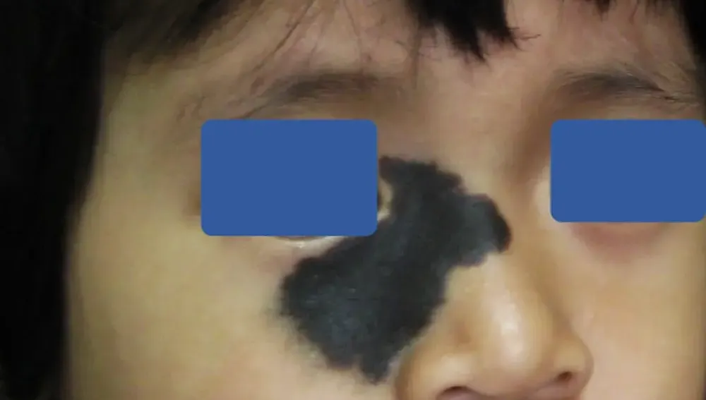 Birthmark Removal dengan Laser di Surabaya Skin Centre - Surabaya Skin Centre