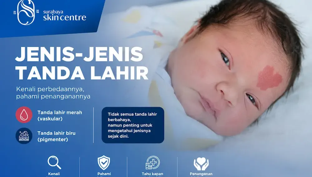 Bercak Merah di Pipi Anak, Bahaya Nggak Sih? Kenali Jenis Tanda Lahir Sejak Dini - Surabaya Skin Centre