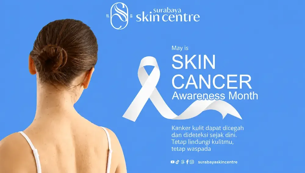 Pentingnya Melindungi Kulit dari Paparan Sinar UV di Surabaya - Surabaya Skin Centre