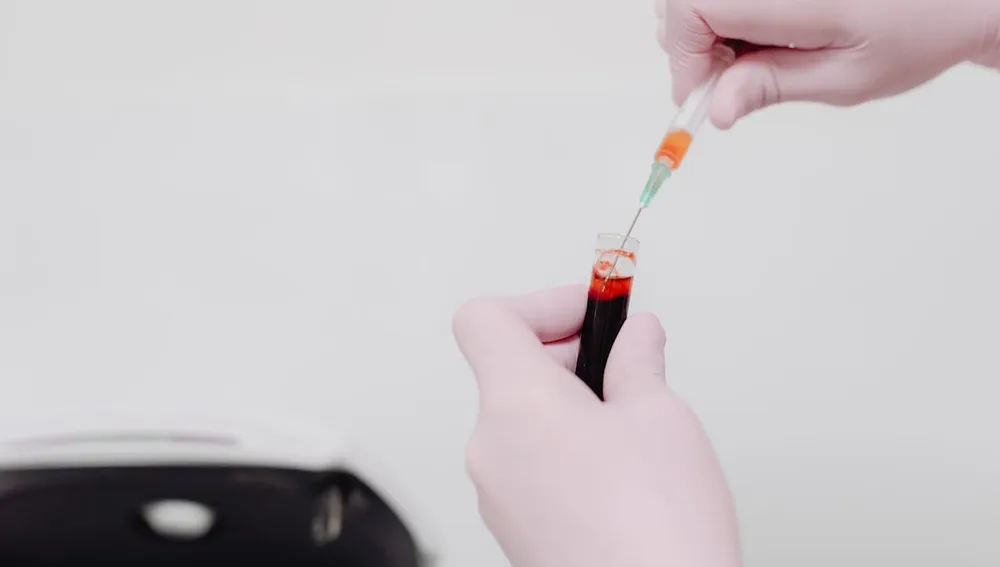 terapi PRP anti aging - sampel darah untuk perawatan Platelet Rich Plasma, kulit kencang dan rambut sehat di Surabaya Skin Centre