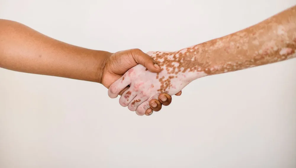 mengenal psoriasis - konsultasi dengan dokter kulit, jabat tangan dokter dan pasien di Surabaya Skin Centre untuk penanganan psoriasis