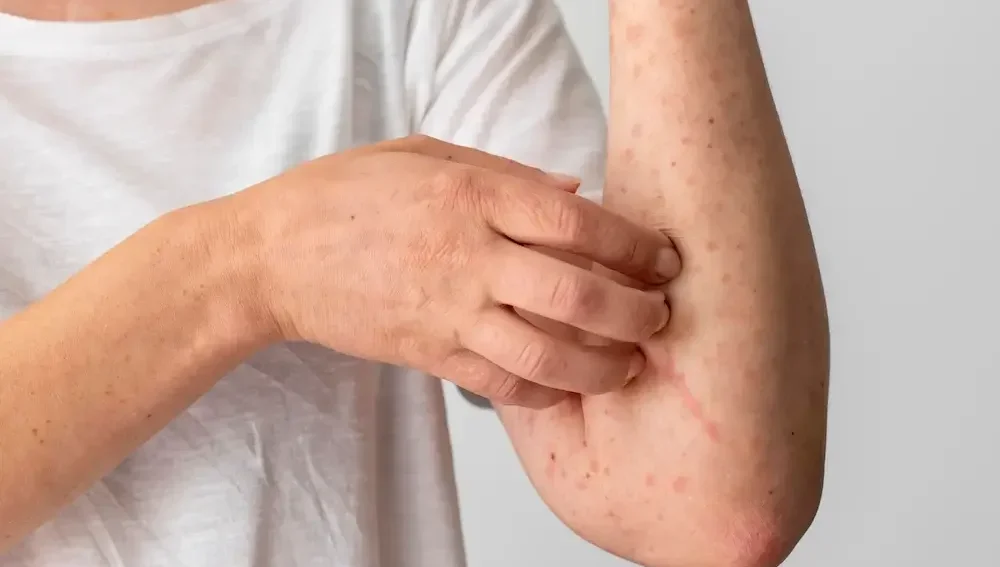 7 Penyebab Biduran Paling Umum Cara Mengatasinya - Surabaya Skin Centre